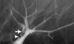 Galaktografi (duktografi) nedir ?