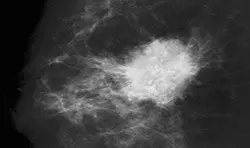 Galaktografi nasıl yapılıyor?