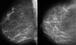 Mamografi ve diğer meme için yapılan görüntülemelerde geçen BİRADS sınıflaması nedir ?